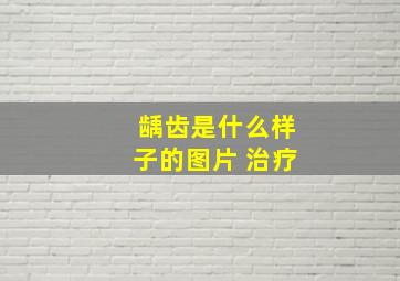 龋齿是什么样子的图片 治疗